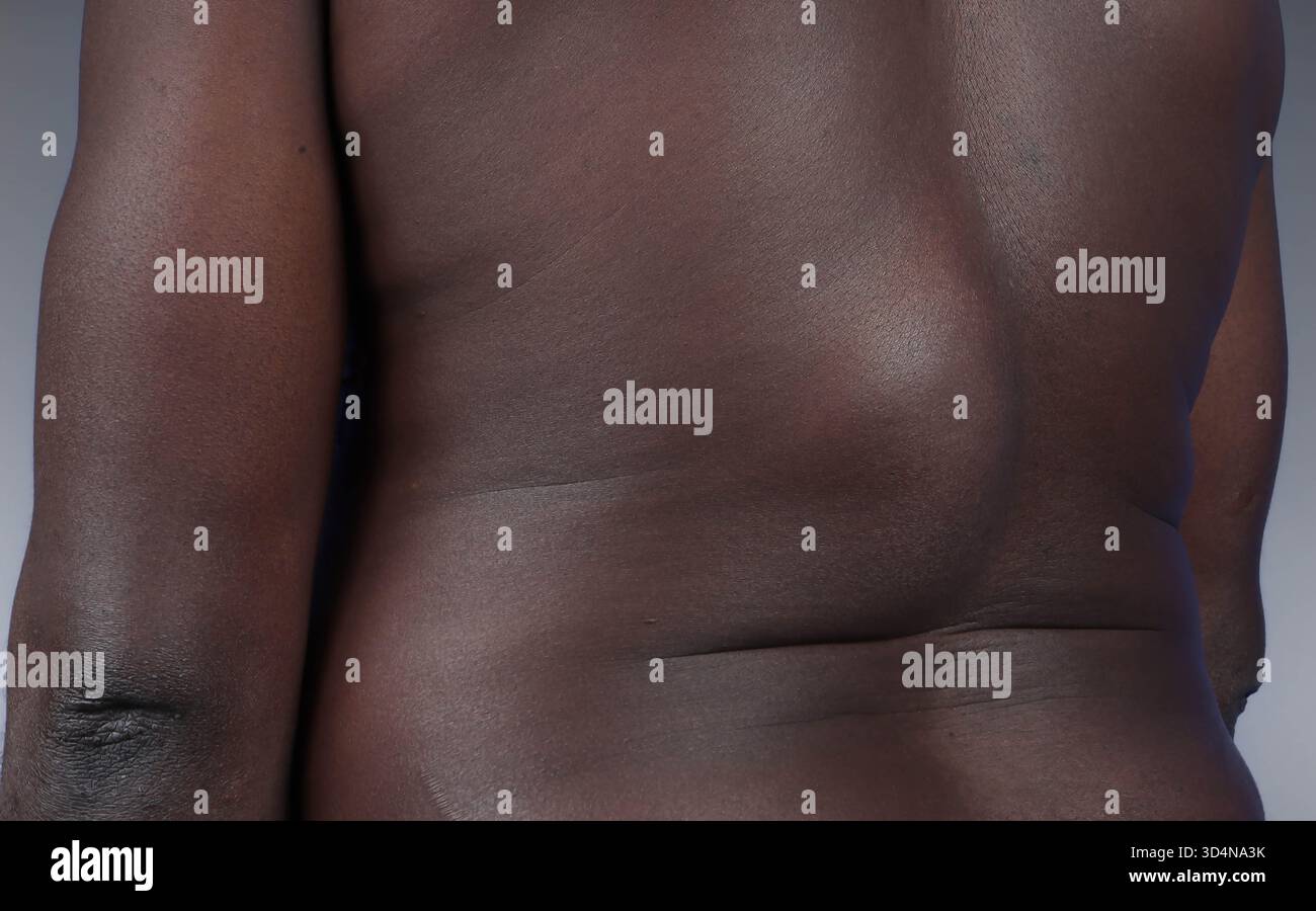 Lipoma benigno della schiena in un uomo di 44 anni. Foto Stock