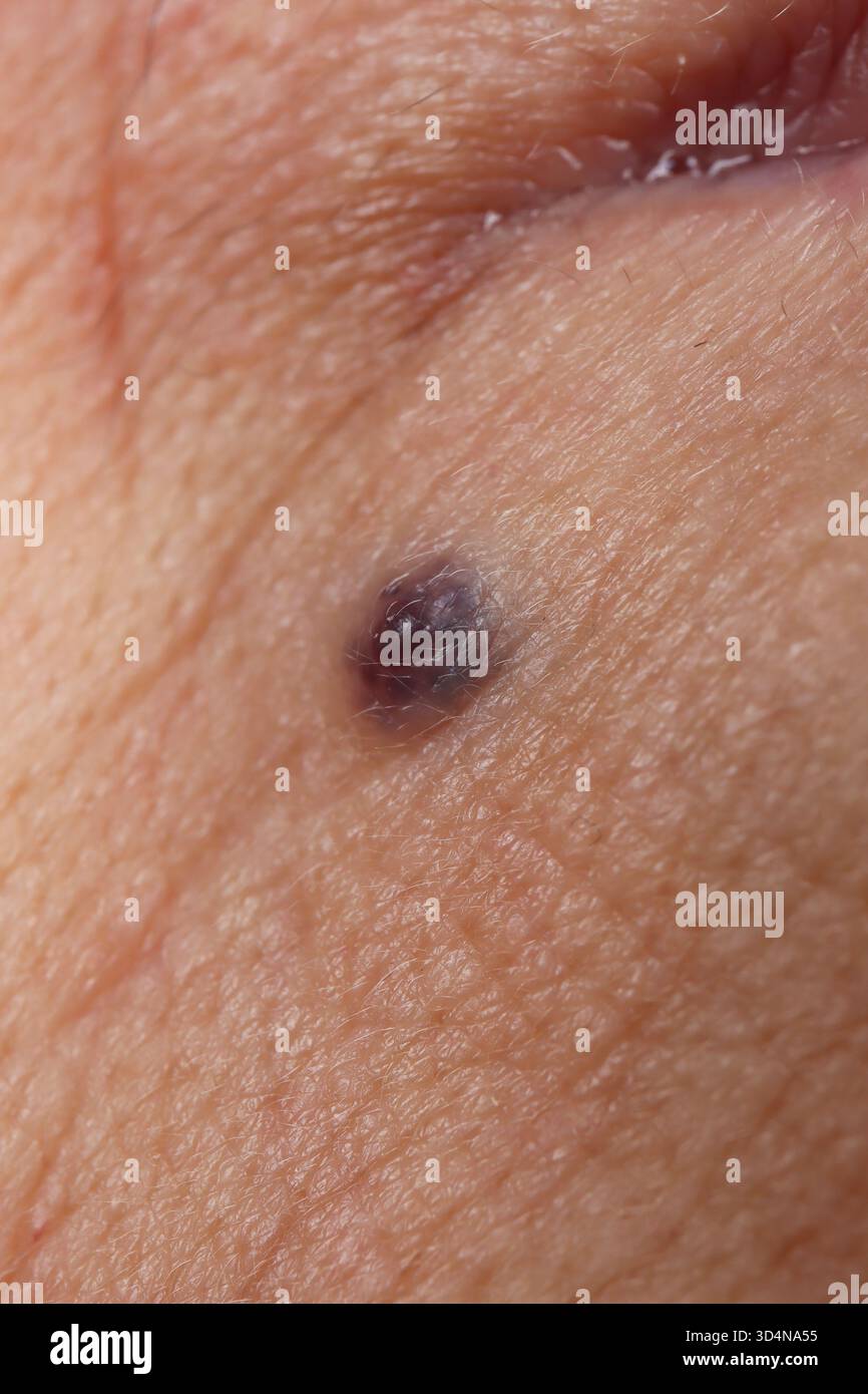 Angioma trombosato del labbro senza segni di neoplasia maligna del labbro in una donna di 74 anni. Foto Stock