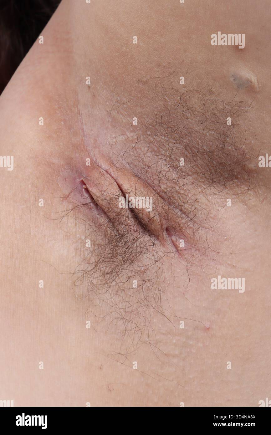 Malattia di Verneuil ascellare in una donna di 38 anni. Foto Stock