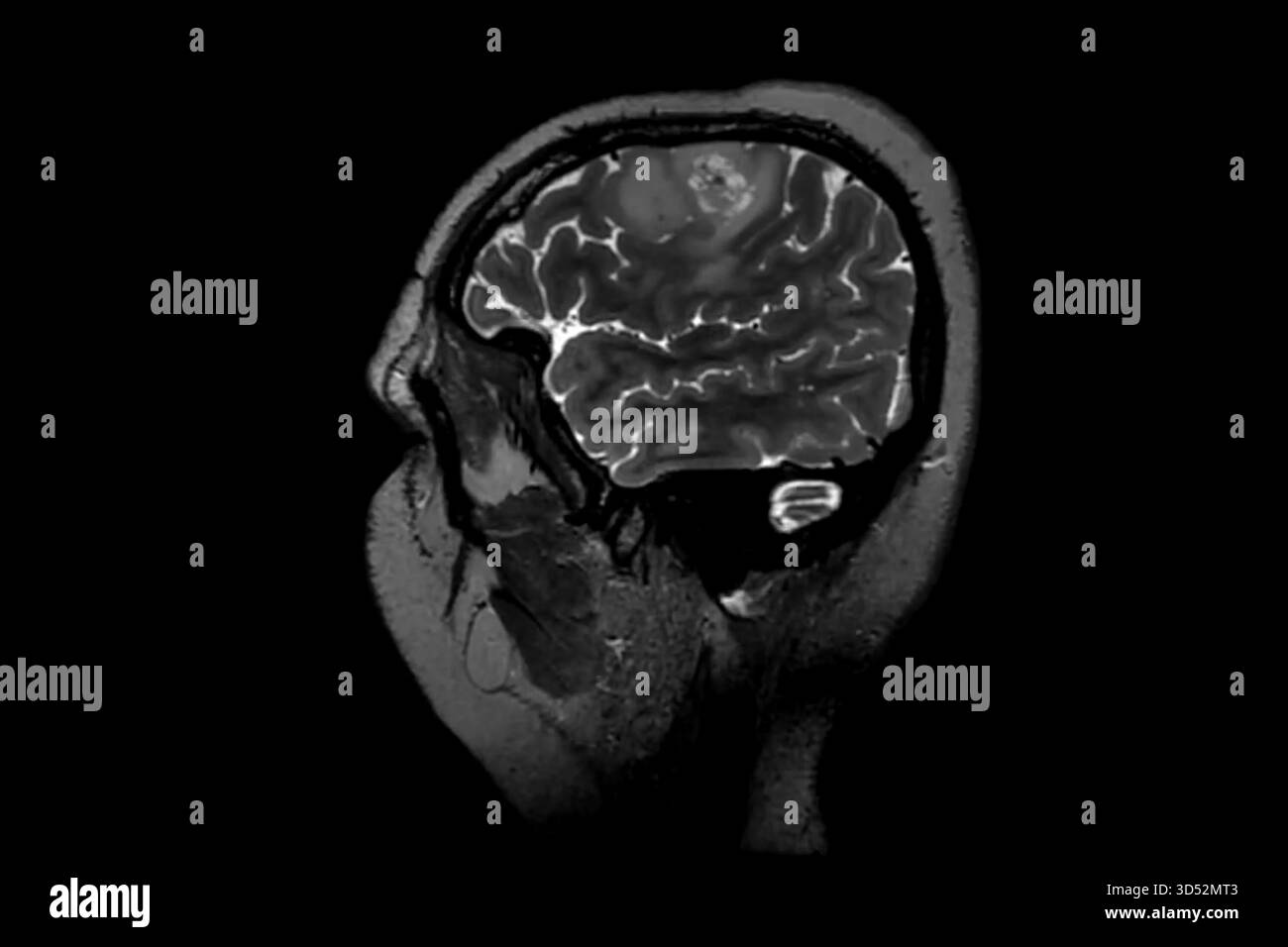 Imaging di risonanza computerizzata del cervello umano Foto Stock