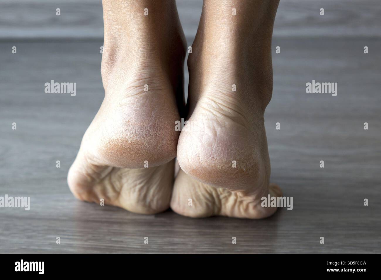 Primo piano di tacchi asciutti e incrinati di una persona in piedi su un pavimento di legno, evidenziando la consistenza ruvida della pelle e la necessità di cura dei piedi Foto Stock