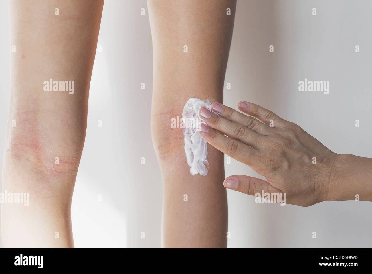 La madre cosparge la pelle rossa della figlia di 7 anni sotto le ginocchia con una crema idratante speciale per la pelle atopica, prurito di dermatite atopica, Foto Stock
