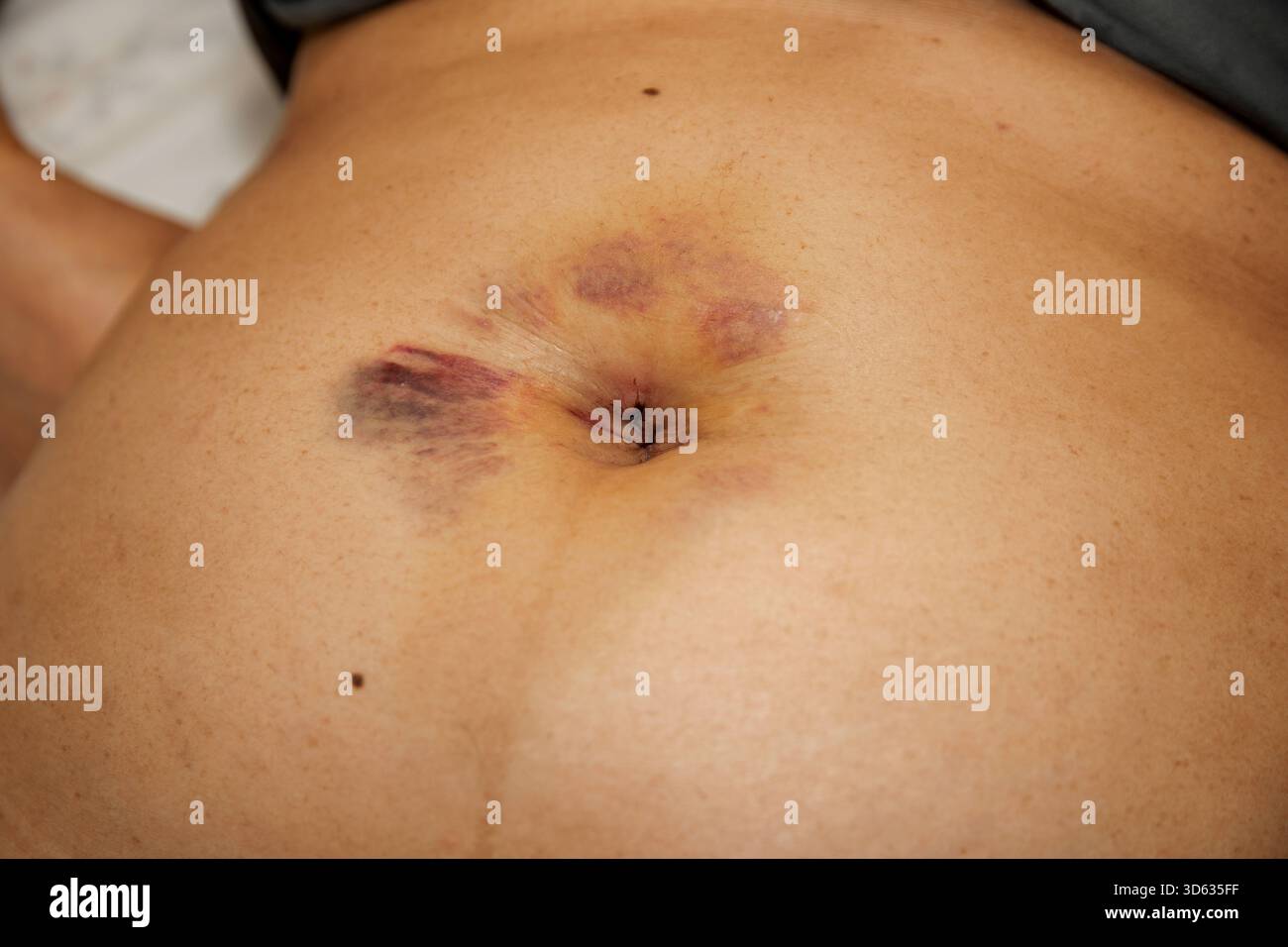 Addome postoperatorio che mostra incisione ombelicale e lividi dopo colecistectomia laparoscopica Foto Stock