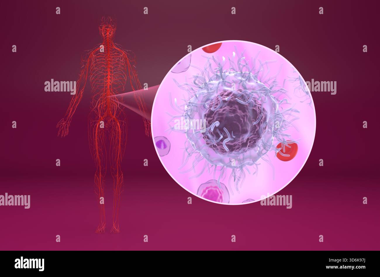 Leucemia a cellule pelose (HCL) nel flusso sanguigno - Vista isometrica illustrazione 3d. Foto Stock