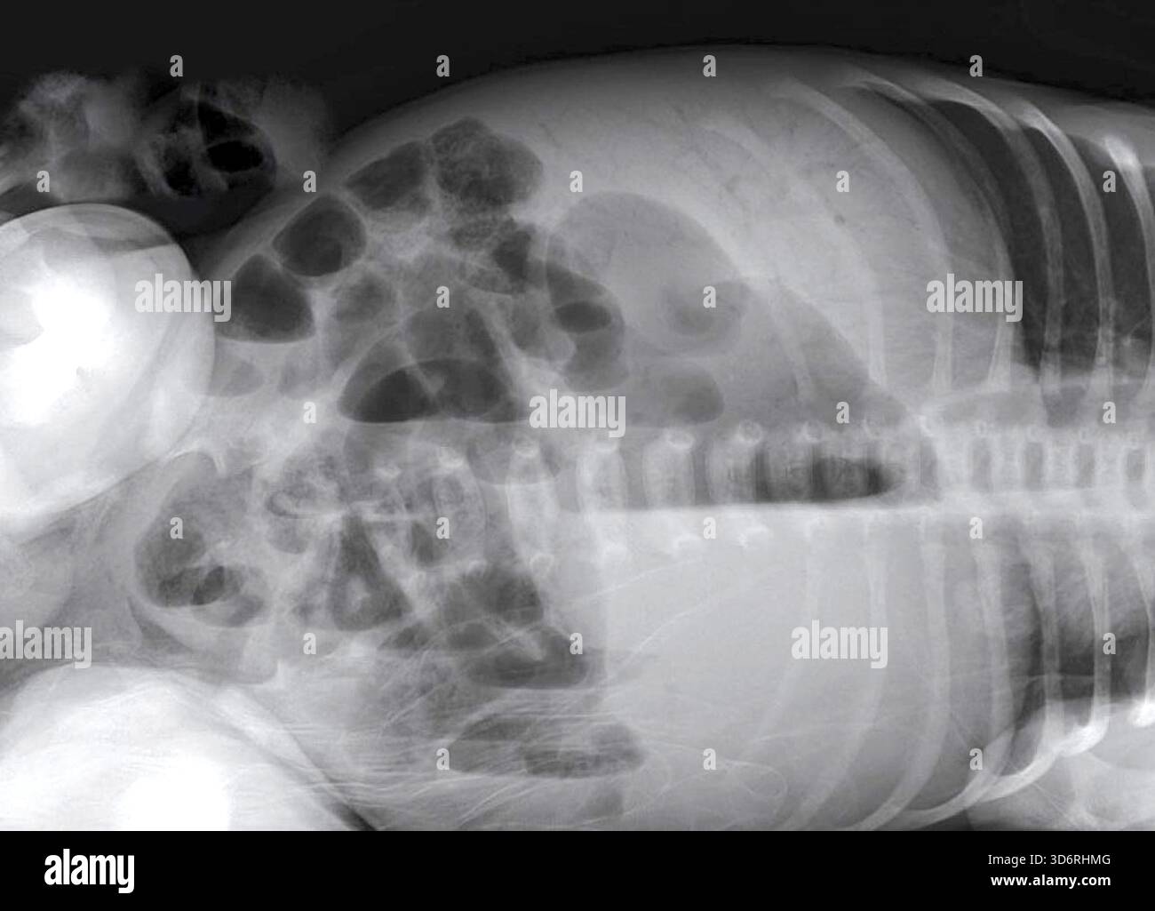 Raggi X che mostrano aria nel sistema venoso portale. Questa condizione, nota anche come pneumatosi portalis, è l'accumulo di gas nella vena porta e nei suoi rami. Ciò può verificarsi a causa di ischemia intestinale, infezione o lesioni alla mucosa che consentono l'ingresso del gas nella circolazione portale. I sintomi variano ma includono dolore addominale, febbre o segni di sepsi. Il trattamento dipende dalla causa sottostante e può variare dalle cure di supporto e antibiotici, fino all'intervento chirurgico urgente. Foto Stock