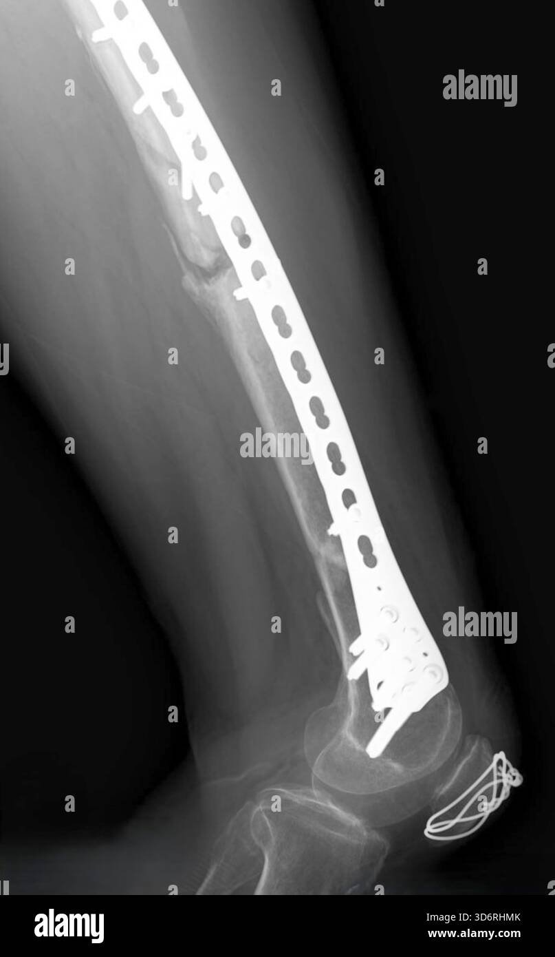 Radiografia di un femore fratturato che è stato fissato internamente. La fissazione stabilizza l'osso per mantenere l'allineamento e favorire una corretta guarigione. Questo intervento chirurgico è necessario nei casi più gravi in cui le ossa si sono spostate fuori posizione. La fisioterapia viene utilizzata nella riabilitazione. Foto Stock
