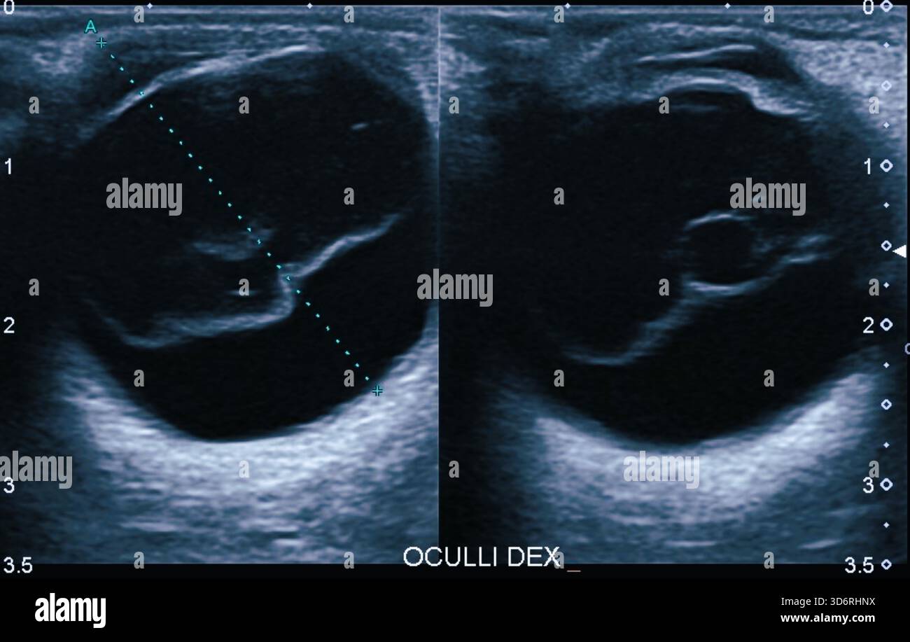 Scansione ecografica del distacco vitreo posteriore (PVD). La PVD si verifica quando il gel vitreo si stacca dallo strato retinico nella parte posteriore dell'occhio. Diventa più comune con l'età perché il vitreo diventa più liquido. I sintomi possono includere nuovi galleggianti, lampi di luce, o visione offuscata. La gestione generalmente implica il monitoraggio, a meno che non si sviluppino complicazioni. Foto Stock