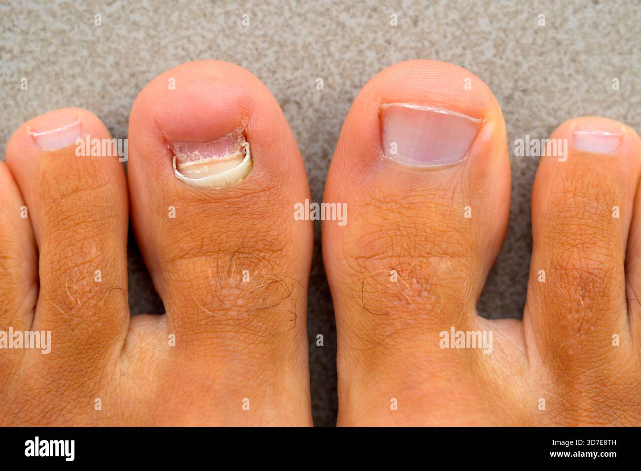 Rimosso il vecchio chiodo caduto dal chiodo a punta grande dopo un danno meccanico sotto il chiodo. Lesione delle unghie a punta grossa. Un podiatra lavora malato Foto Stock