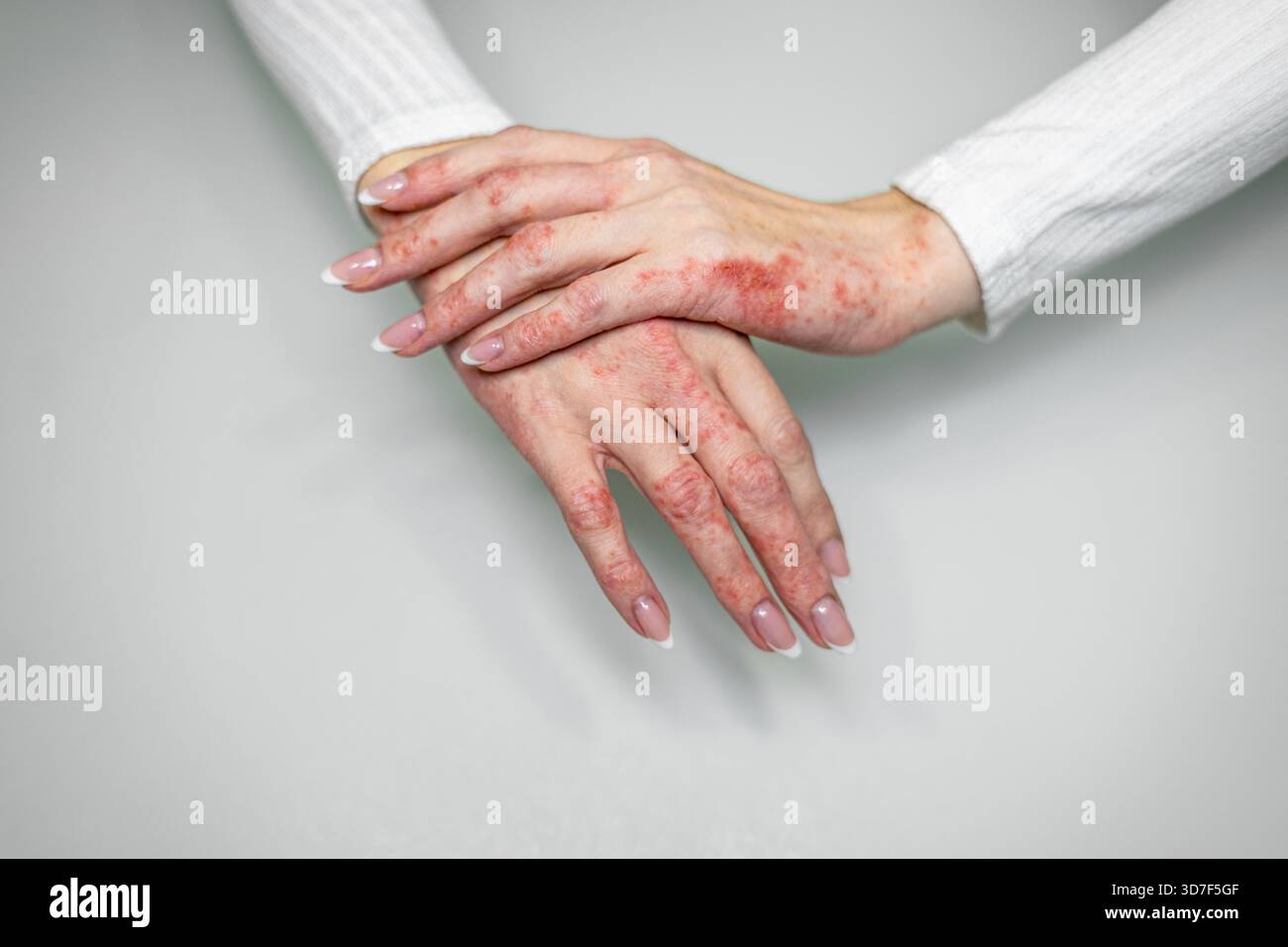 Le mani sono mostrate con rossore visibile e irritazione causata da condizioni della pelle come eczema, dermatite da contatto e psoriasi. La pelle appare asciutta e. Foto Stock