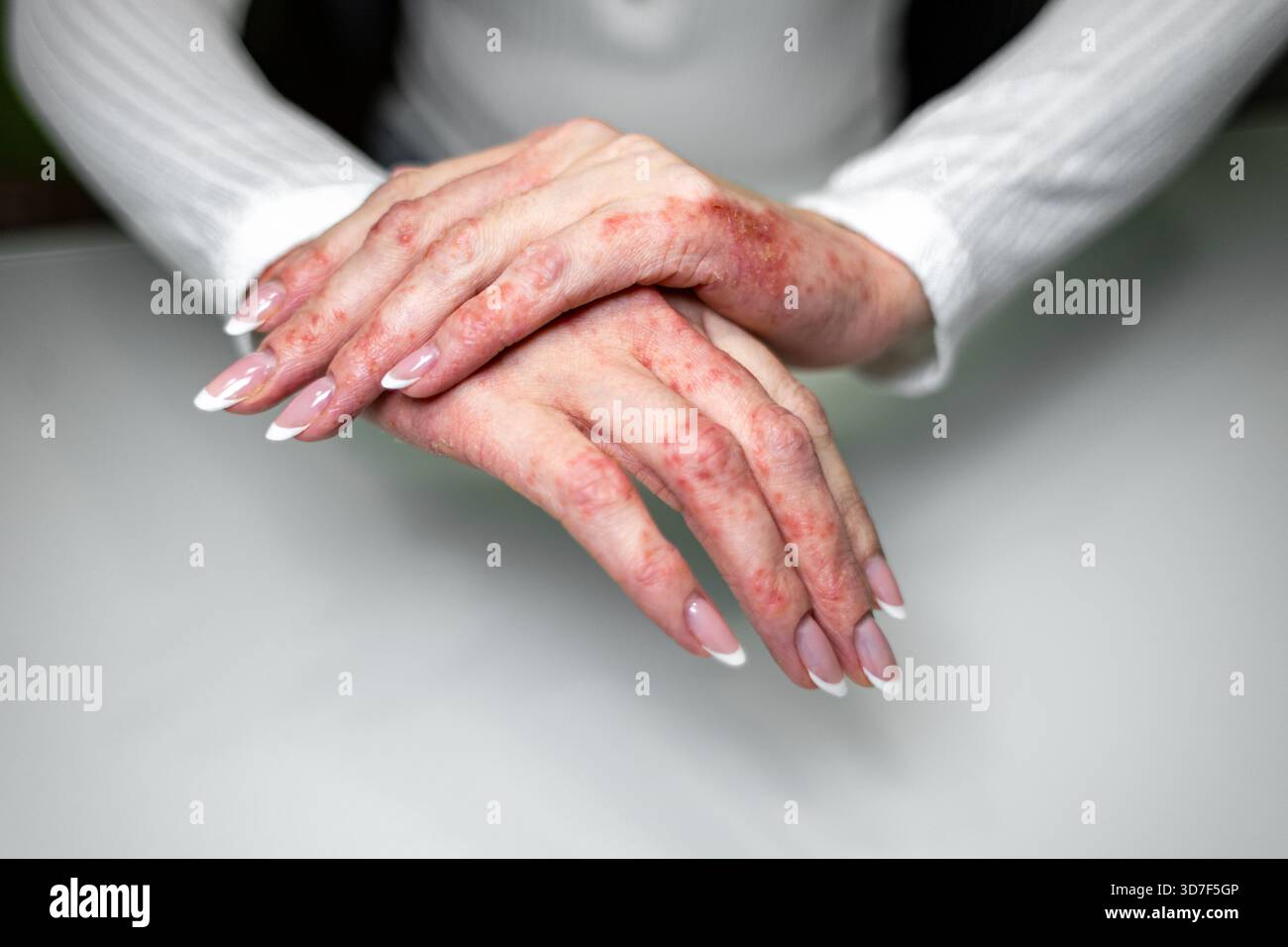 Una persona siede a un tavolo, mostrando le mani colpite da eczema, psoriasi e dermatite da contatto. La pelle mostra rossore e irritazione, evidenziando Foto Stock