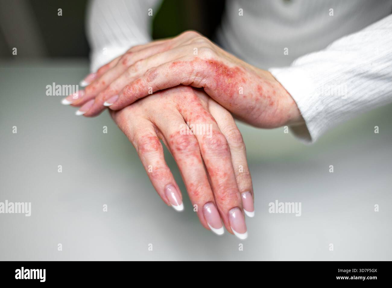 Le mani con irritazione visibile e rossore mostrano sintomi di varie condizioni della pelle tra cui eczema e dermatite. L'impostazione è in interni con nat Foto Stock