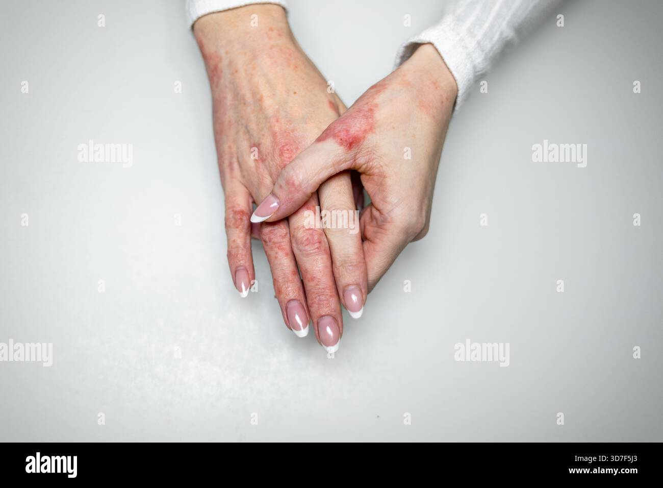 Due mani sono unite, rivelando condizioni cutanee come eczema, psoriasi e dermatite. Lo sfondo e' una superficie bianca semplice, alta Foto Stock