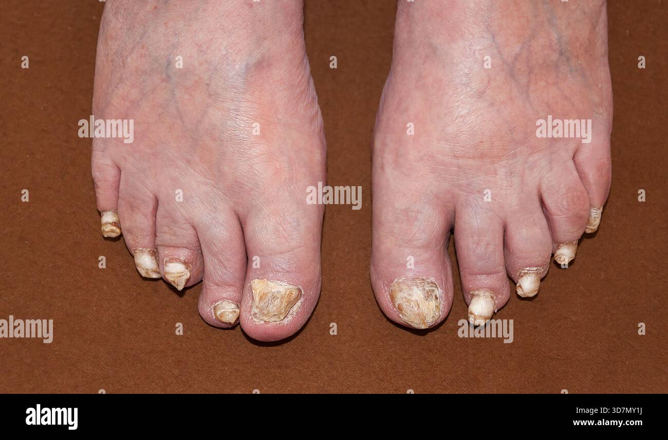 Infezione da funghi dell'unghia del piede (chychomycosis) che provoca unghie scolorite, spesse e fragili. Questo è un caso grave. Foto Stock