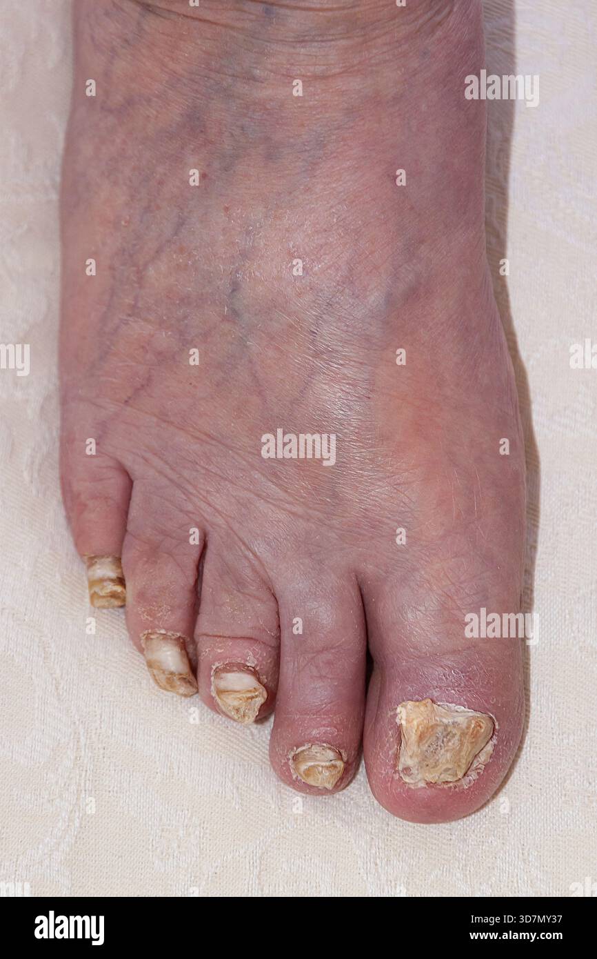 Infezione da funghi dell'unghia del piede (chychomycosis) che provoca unghie scolorite, spesse e fragili. Questo è un caso grave. Foto Stock