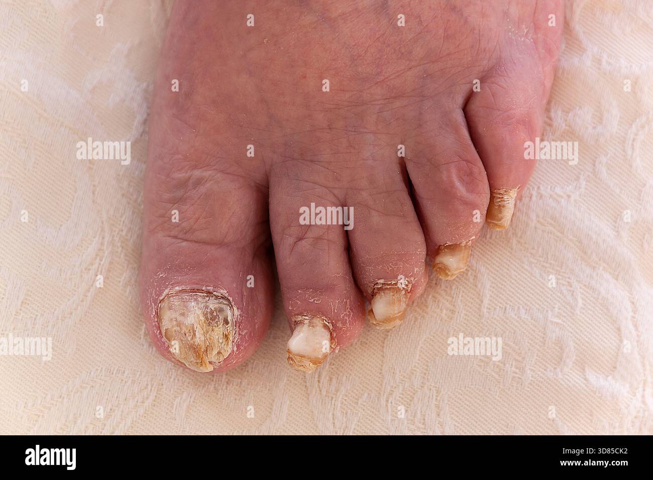 Infezione da funghi dell'unghia del piede (chychomycosis) che provoca unghie scolorite, spesse e fragili. Questo è un caso grave. Foto Stock