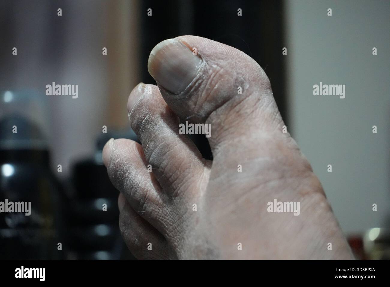 La pelle asciutta sulle dita dei piedi ha bisogno di un balsamo idratante per un sollievo lenitivo e pelle morbida e sana, dettaglio visibile di secchezza Foto Stock