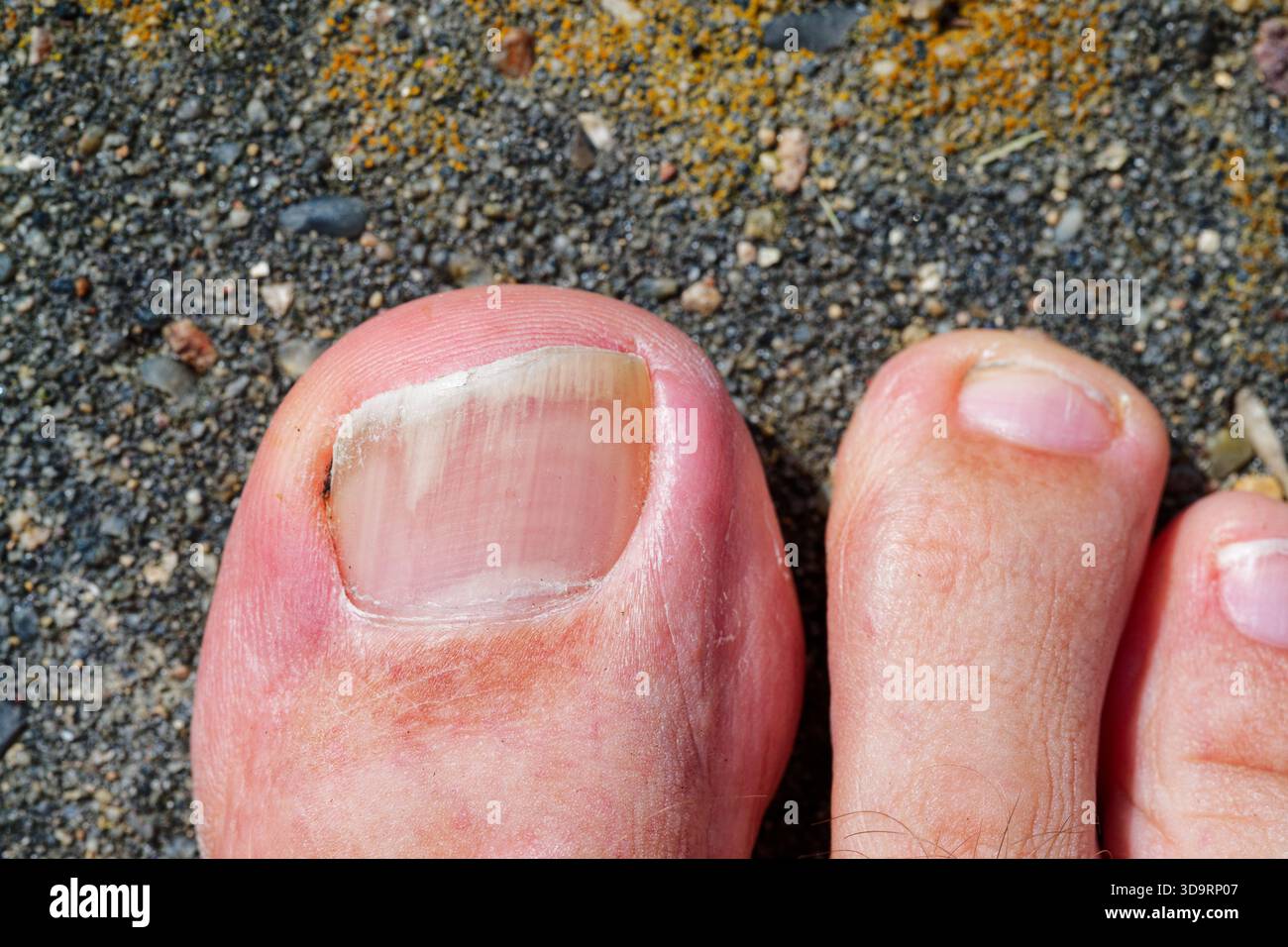 Macro primo piano dell'unghia del piede umano con infezione fungina visibile. Concetto per la salute del piede onicomicosi del fungo delle unghie, trattamento medico, dermatologia, e h Foto Stock