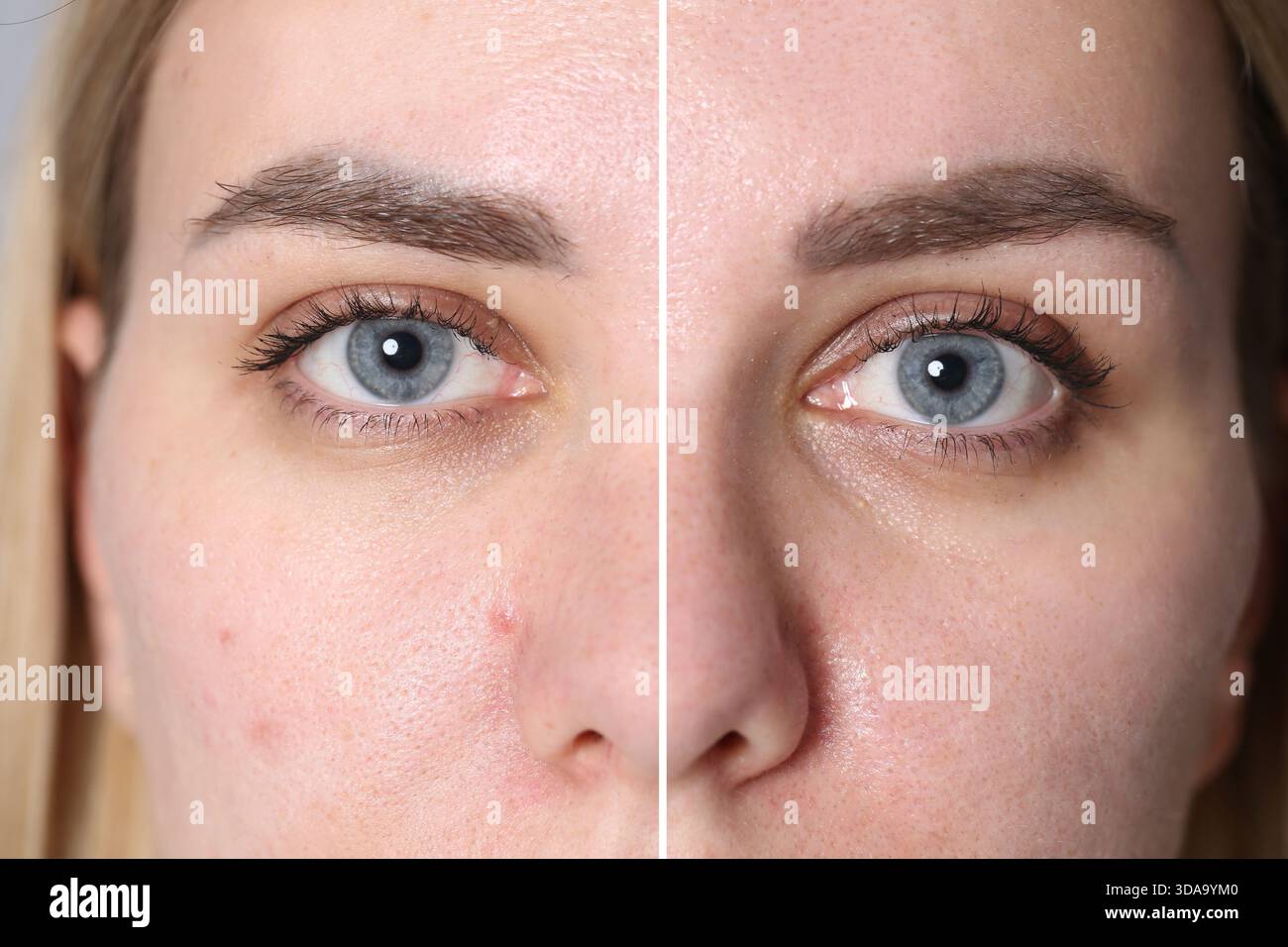 Donna che mostra la sua pelle prima e dopo il trattamento cosmetico, primo piano. Collage Foto Stock