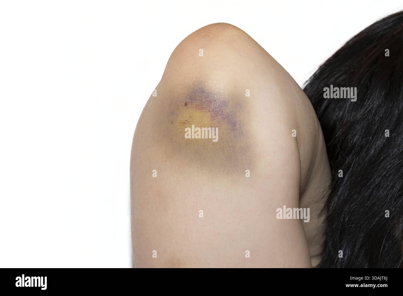 Primo piano di lividi o ematoma di grandi dimensioni sul gomito che mostra più fasi di guarigione e scolorimento Foto Stock