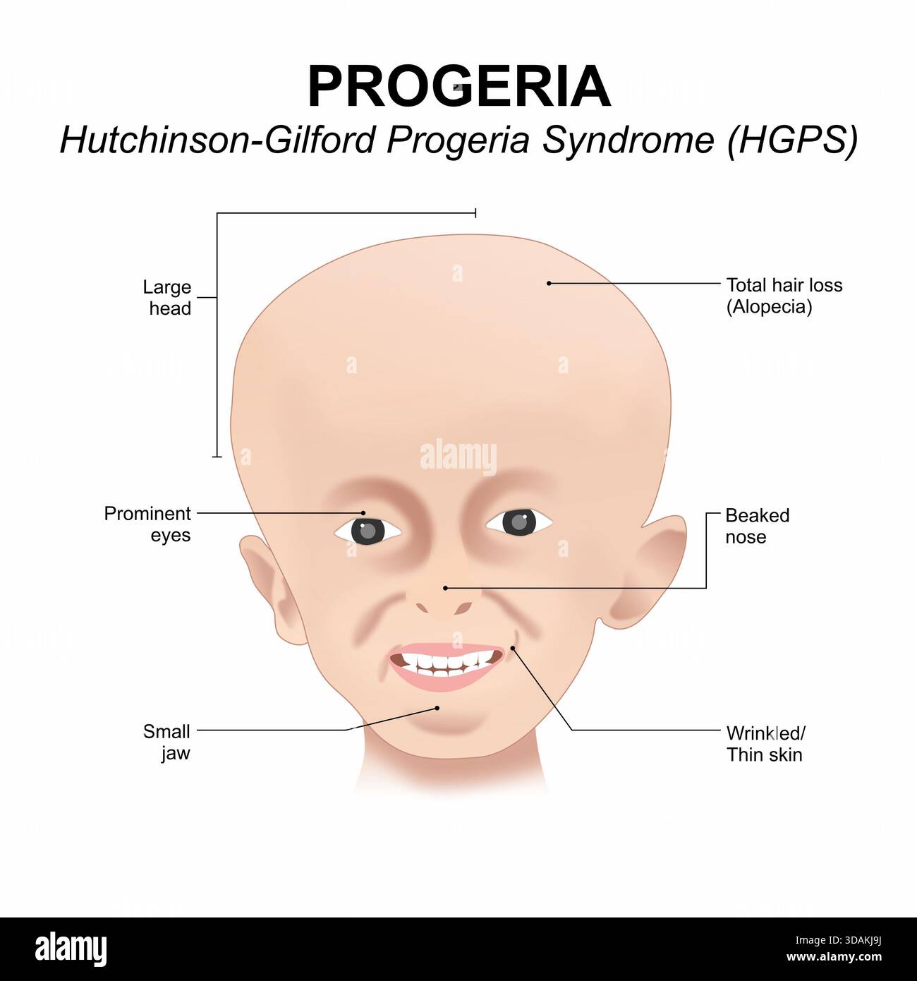 Sindrome di hutchinson gilford progeria immagini e fotografie stock ad ...