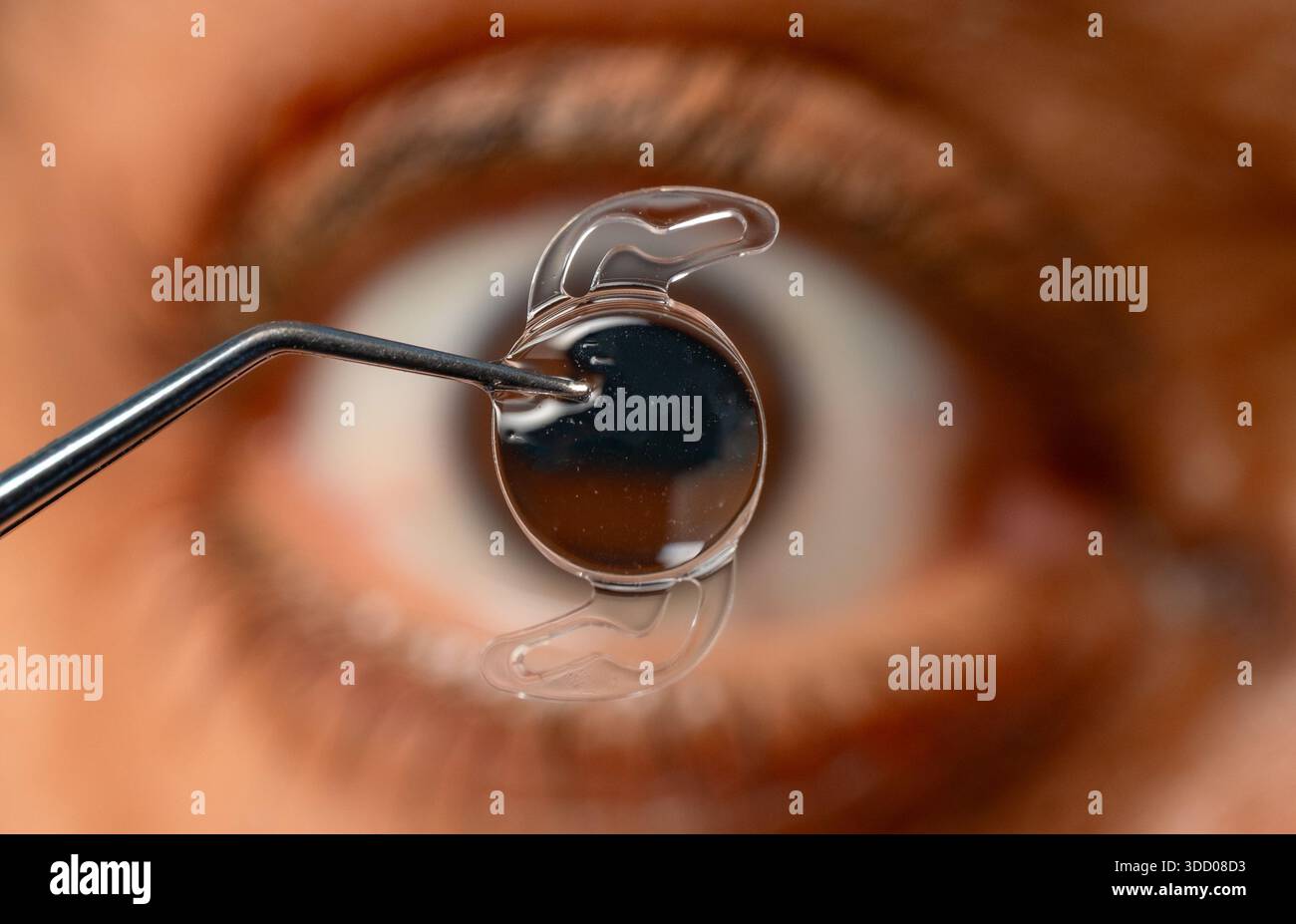 Lente intraoculare pieghevole posizionata prima dell'occhio umano in contesto chirurgico Foto Stock