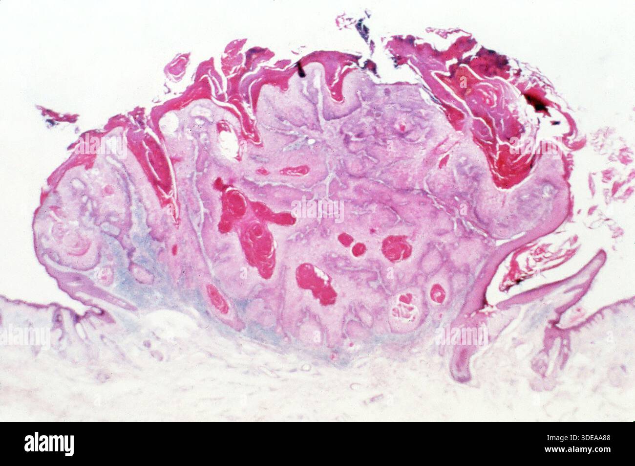 Carcinoma squamoso invasivo, cancro della pelle al microscopio Foto Stock