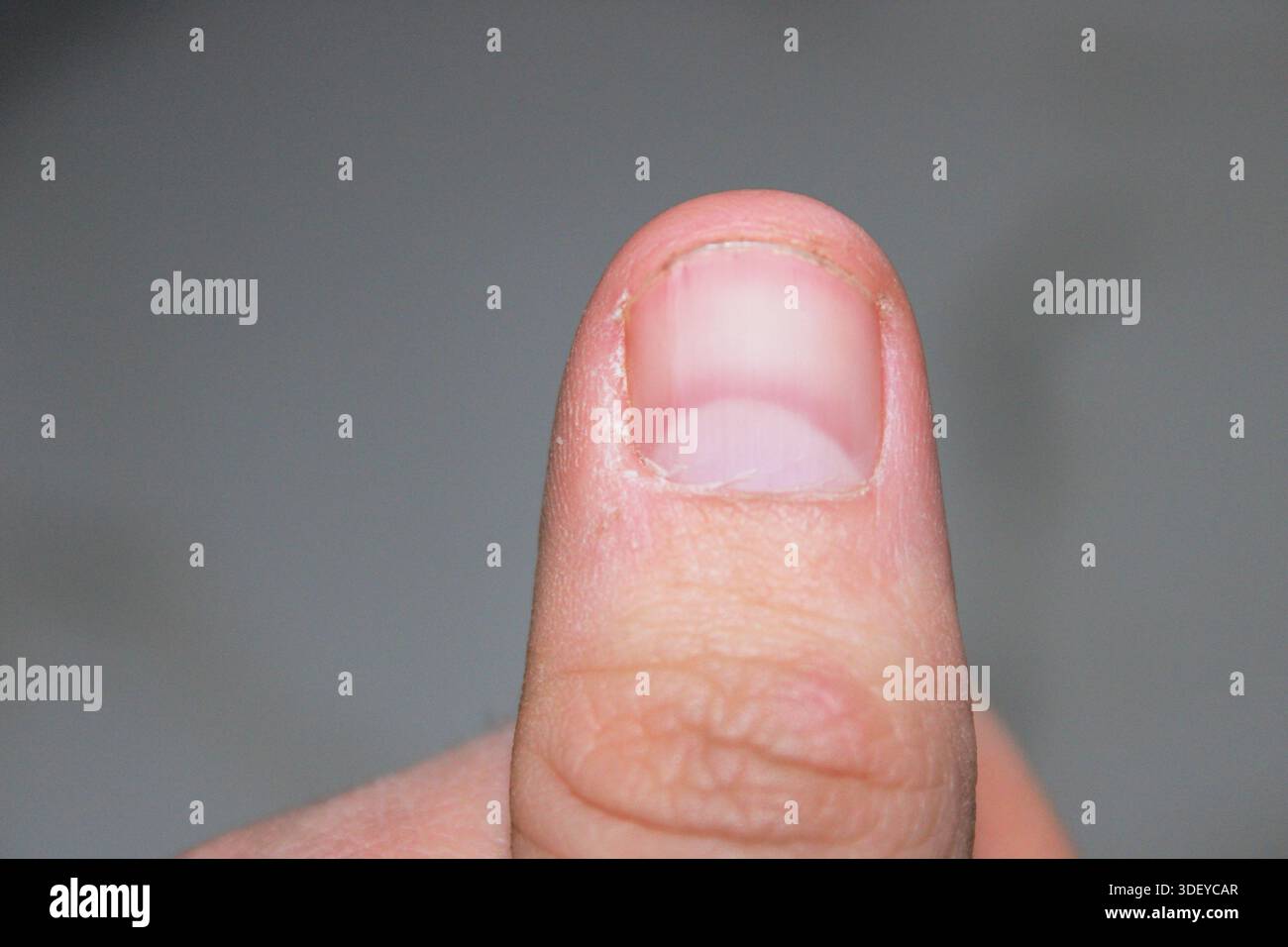 Una persona mostra il pollice con l'unghia parzialmente visibile. La pelle intorno all'unghia ha un po' di secchezza. Questo cattura la salute delle mani e la cura del corpo. Foto Stock