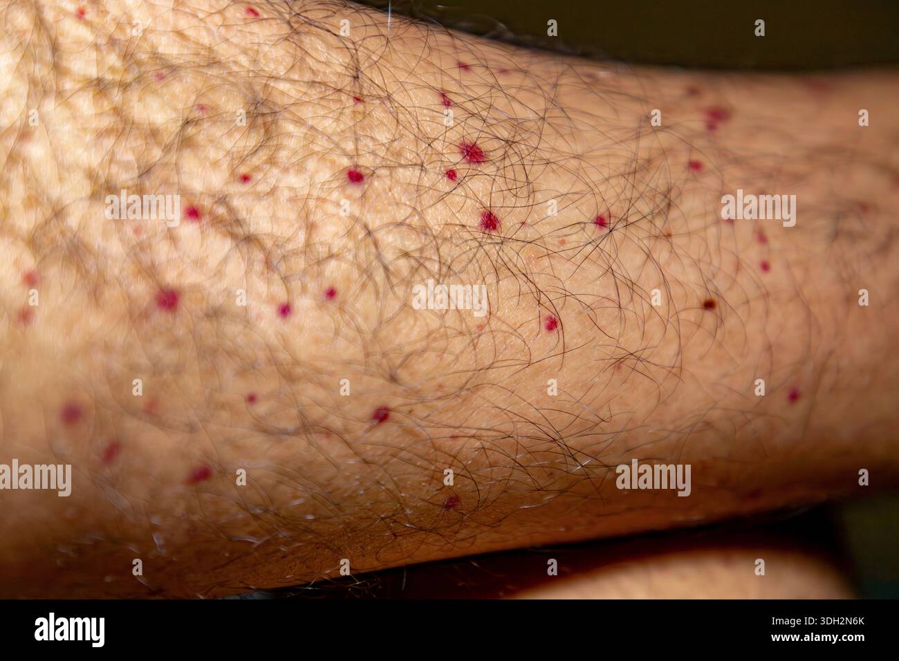 Segni di vasculite visibili su braccia e gambe, che mostrano macchie rosse e infiammazione della pelle correlata a malattia vascolare. Madrid, Spagna. Foto Stock