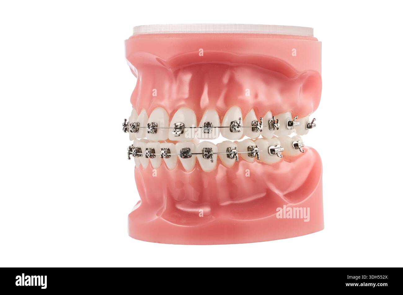 Modello ortodontico dentale con bretelle che mostrano staffe, fili e allineamento per lo studio Foto Stock