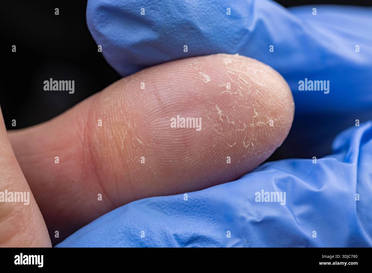 Pelle asciutta, incrinata e danneggiata sulle dita, pelle e salute delle unghie, Foto Stock