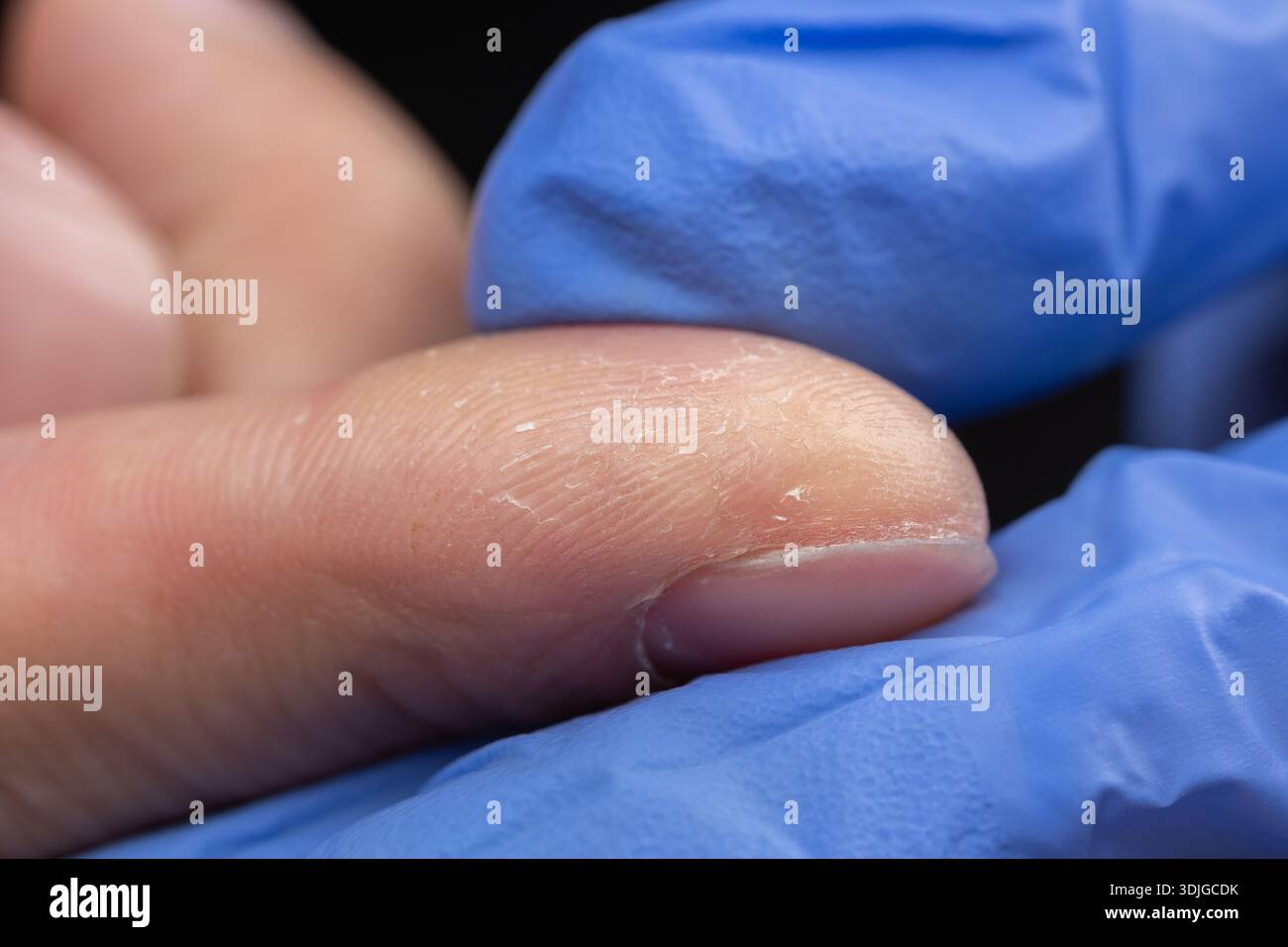Pelle asciutta, incrinata e danneggiata sulle dita, pelle e salute delle unghie, Foto Stock