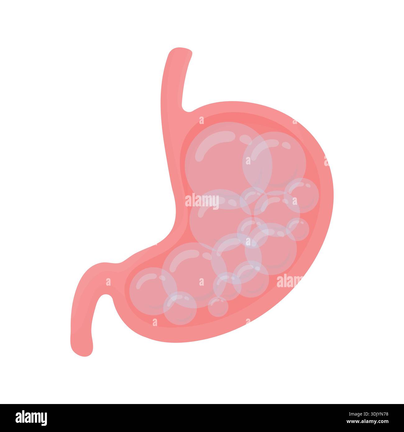 Stomaco umano con gonfiore. Illustrazione Vettoriale