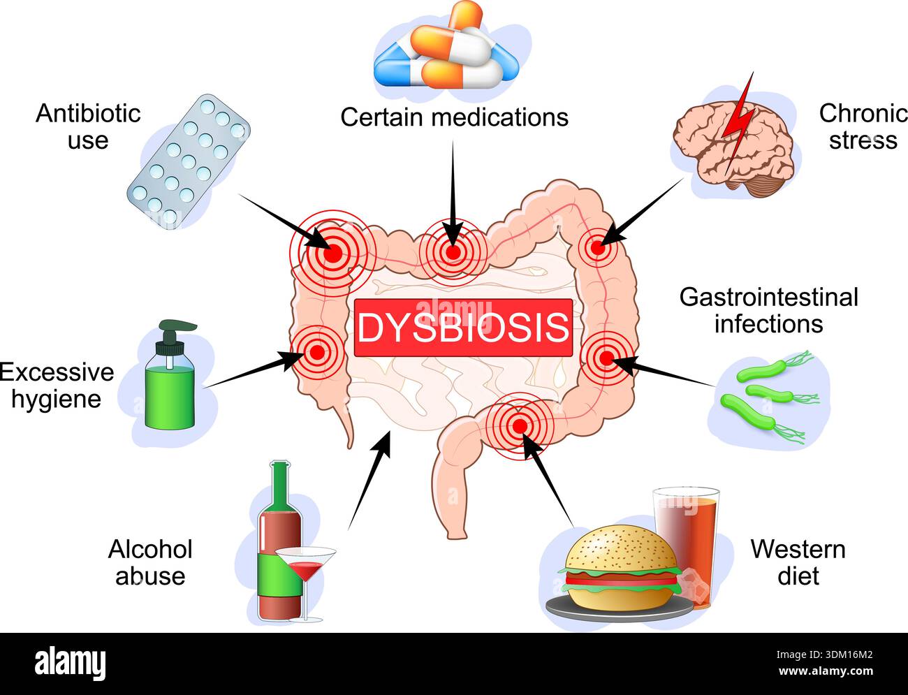 Disbiosi. Possibili cause di disbatteriosi. Influenza e relazione del microbiota intestinale sulla funzione cerebrale. interruzione del microbioma e. Illustrazione Vettoriale