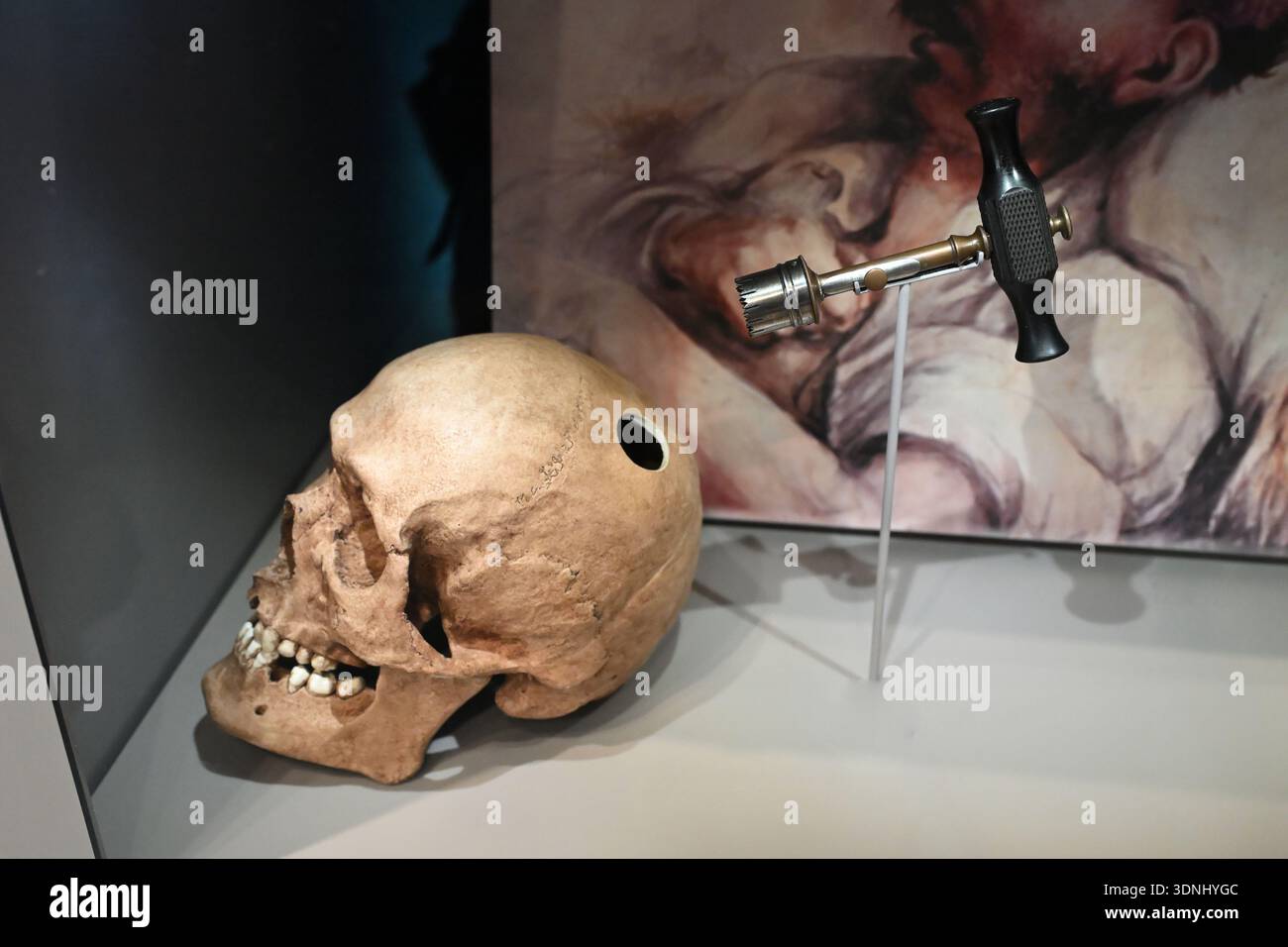 Trefina e modello di un cranio - concetto di chirurgia neurochirurgia salute mentale Foto Stock