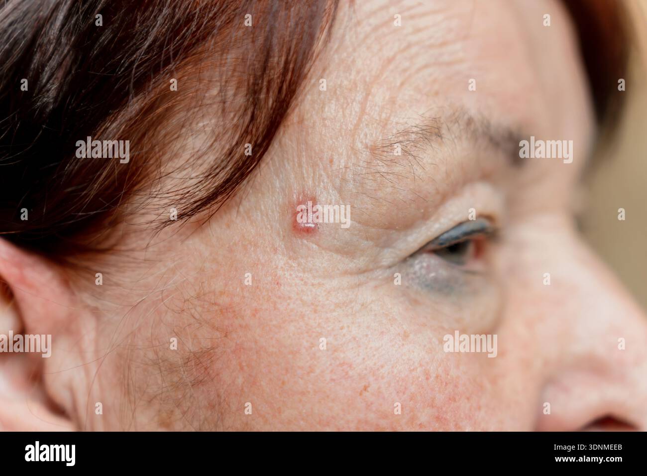 Carcinoma a cellule basali sul tempio di una donna anziana. San Pietroburgo, Russia - 17 gennaio 2026 Foto Stock