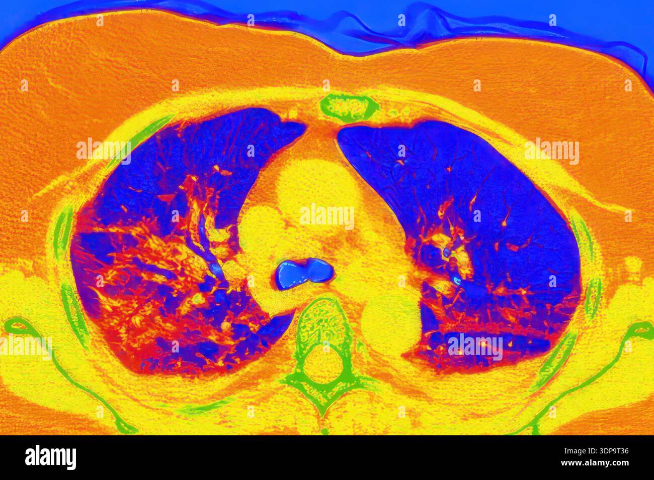 Tomografia computerizzata a colori (CT) di una sezione assiale dei polmoni umani affetti da polmonite da COVID-19, che mostra il normale tessuto polmonare (blu) e le aree bilaterali interessate con opacità del vetro smerigliato e schemi di pavimentazione pazzesca (rosso). Foto Stock