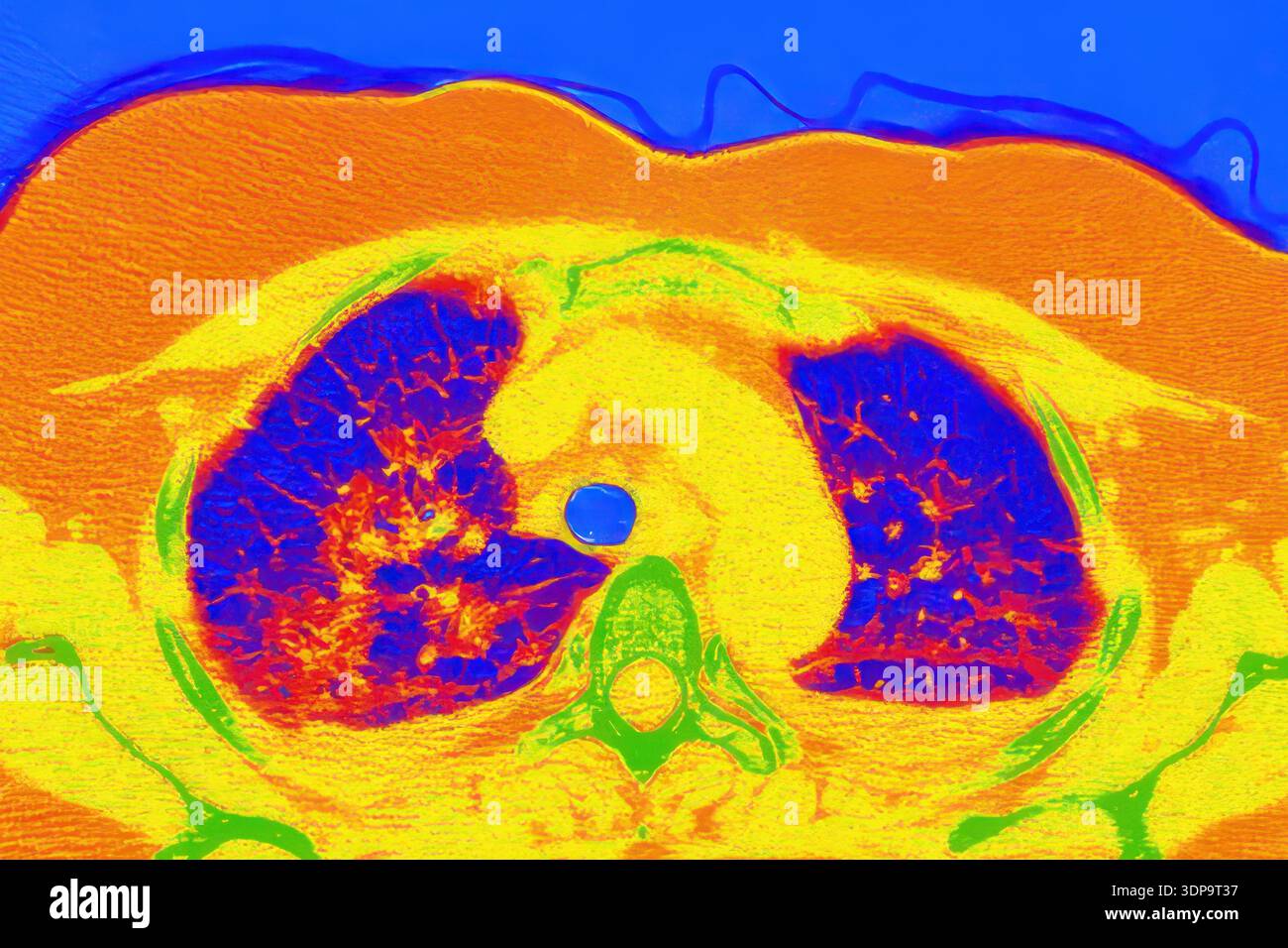 Tomografia computerizzata a colori (CT) di una sezione assiale dei polmoni umani affetti da polmonite da COVID-19, che mostra il normale tessuto polmonare (blu) e le aree bilaterali interessate con opacità del vetro smerigliato e schemi di pavimentazione pazzesca (rosso). Foto Stock