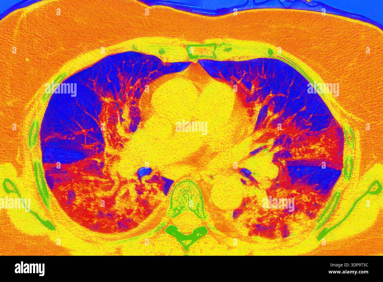 Tomografia computerizzata a colori (CT) di una sezione assiale dei polmoni umani affetti da polmonite da COVID-19, che mostra il normale tessuto polmonare (blu) e le aree bilaterali interessate con opacità del vetro smerigliato e schemi di pavimentazione pazzesca (rosso). Foto Stock