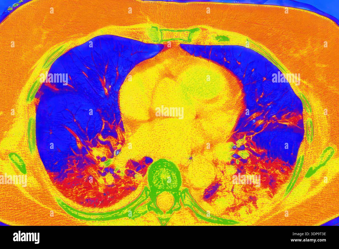 Tomografia computerizzata a colori (CT) di una sezione assiale dei polmoni umani affetti da polmonite da COVID-19, che mostra il normale tessuto polmonare (blu) e le aree bilaterali interessate con opacità del vetro smerigliato e schemi di pavimentazione pazzesca (rosso). Foto Stock