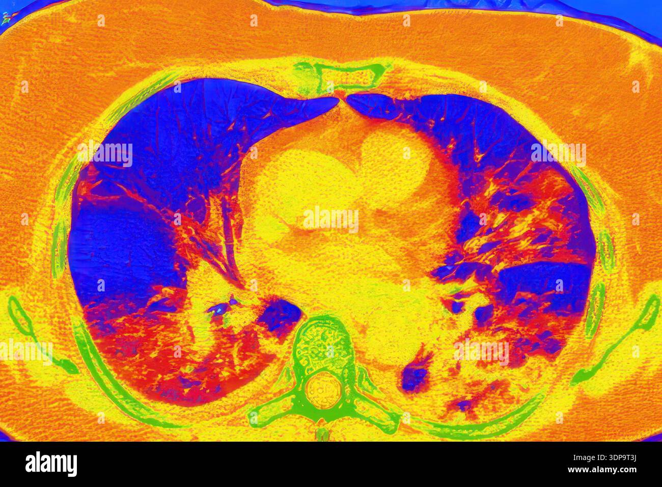 Tomografia computerizzata a colori (CT) di una sezione assiale dei polmoni umani affetti da polmonite da COVID-19, che mostra il normale tessuto polmonare (blu) e le aree bilaterali interessate con opacità del vetro smerigliato e schemi di pavimentazione pazzesca (rosso). Foto Stock