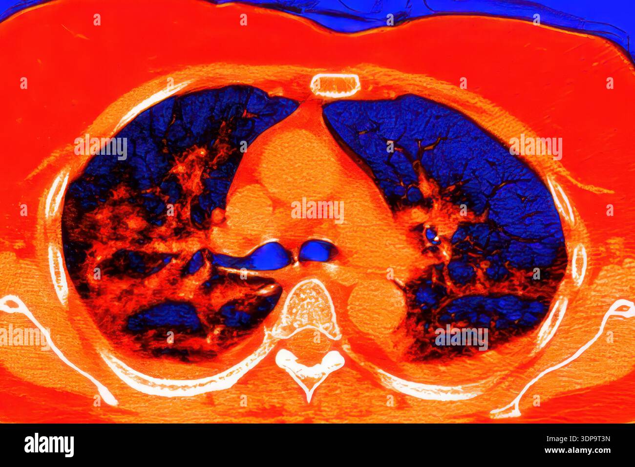 Tomografia computerizzata a colori (CT) di una sezione assiale dei polmoni umani affetti da polmonite da COVID-19, che mostra il normale tessuto polmonare (blu scuro) e le aree bilaterali interessate con opacità del vetro smerigliato e schemi di pavimentazione pazzesca (rosso). Foto Stock