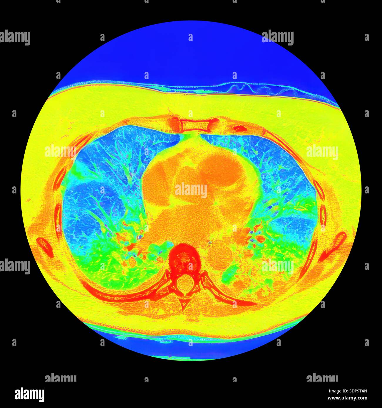 Tomografia computerizzata a colori (CT) di una sezione assiale dei polmoni umani affetti da polmonite da COVID-19, che mostra il normale tessuto polmonare (blu) e le aree bilaterali interessate con opacità in vetro smerigliato e schemi di pavimentazione pazzesca (da verde a giallo). Foto Stock