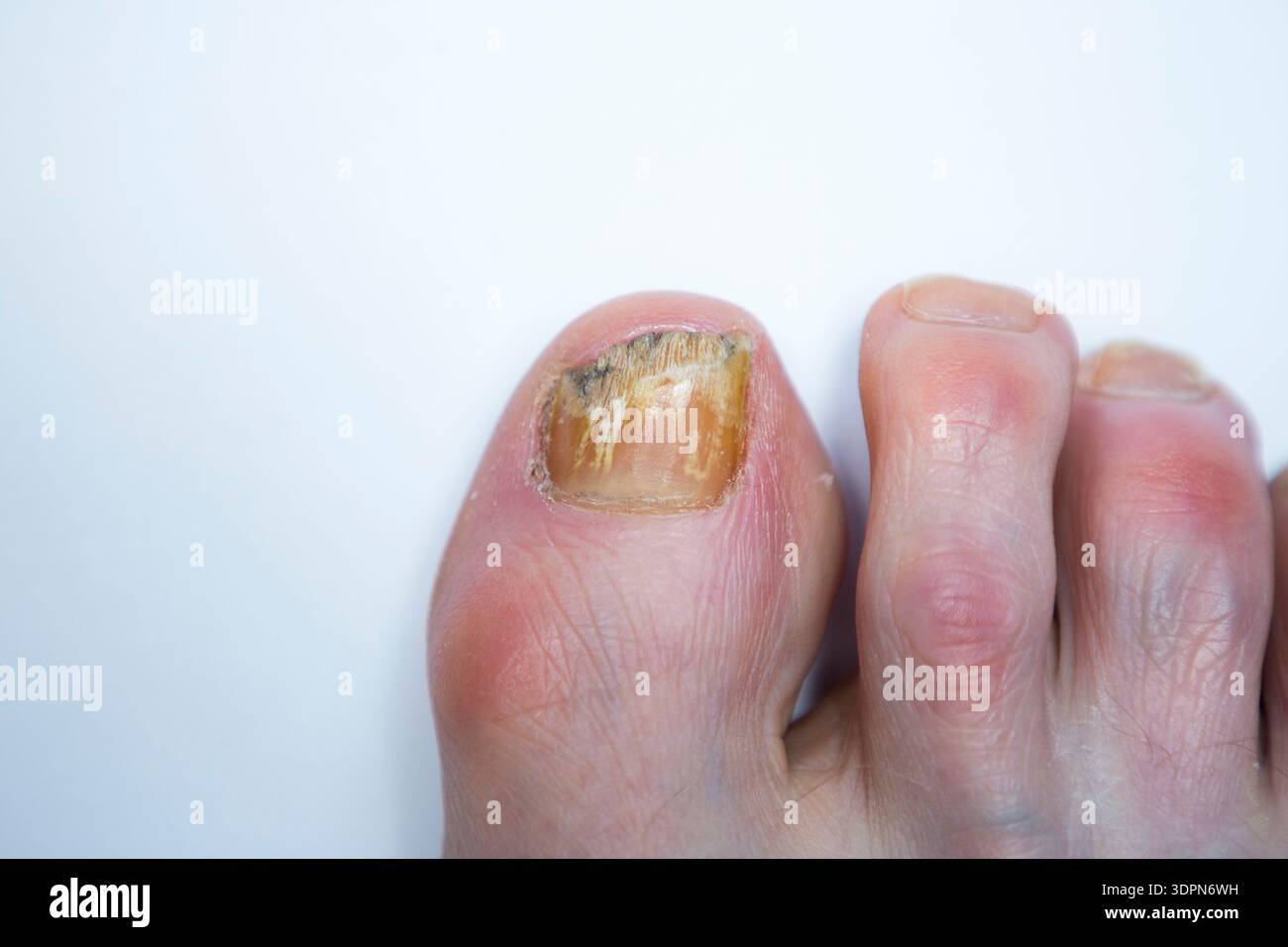 Unghia di recupero con infezione fungina che viene trattata con lacca medicata Amorolfine 5% per unghie; trattamento antimicotico applicato localmente. (147) Foto Stock