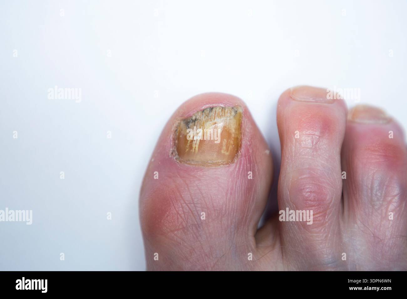 Unghia di recupero con infezione fungina che viene trattata con lacca medicata Amorolfine 5% per unghie; trattamento antimicotico applicato localmente. (147) Foto Stock