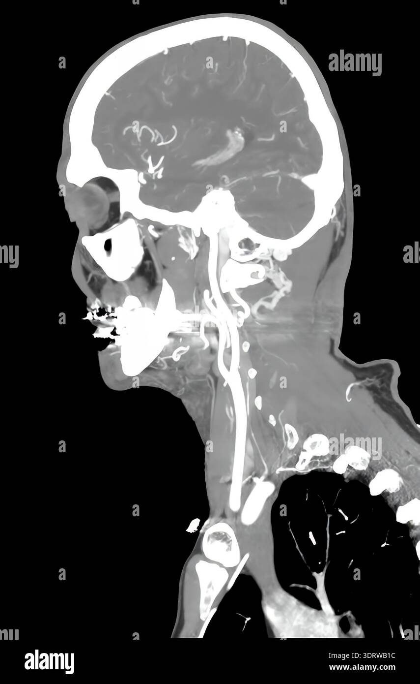 Scansione TC della testa umana che mostra il cervello e il sistema vascolare di un paziente maschio sano di 72 anni Foto Stock