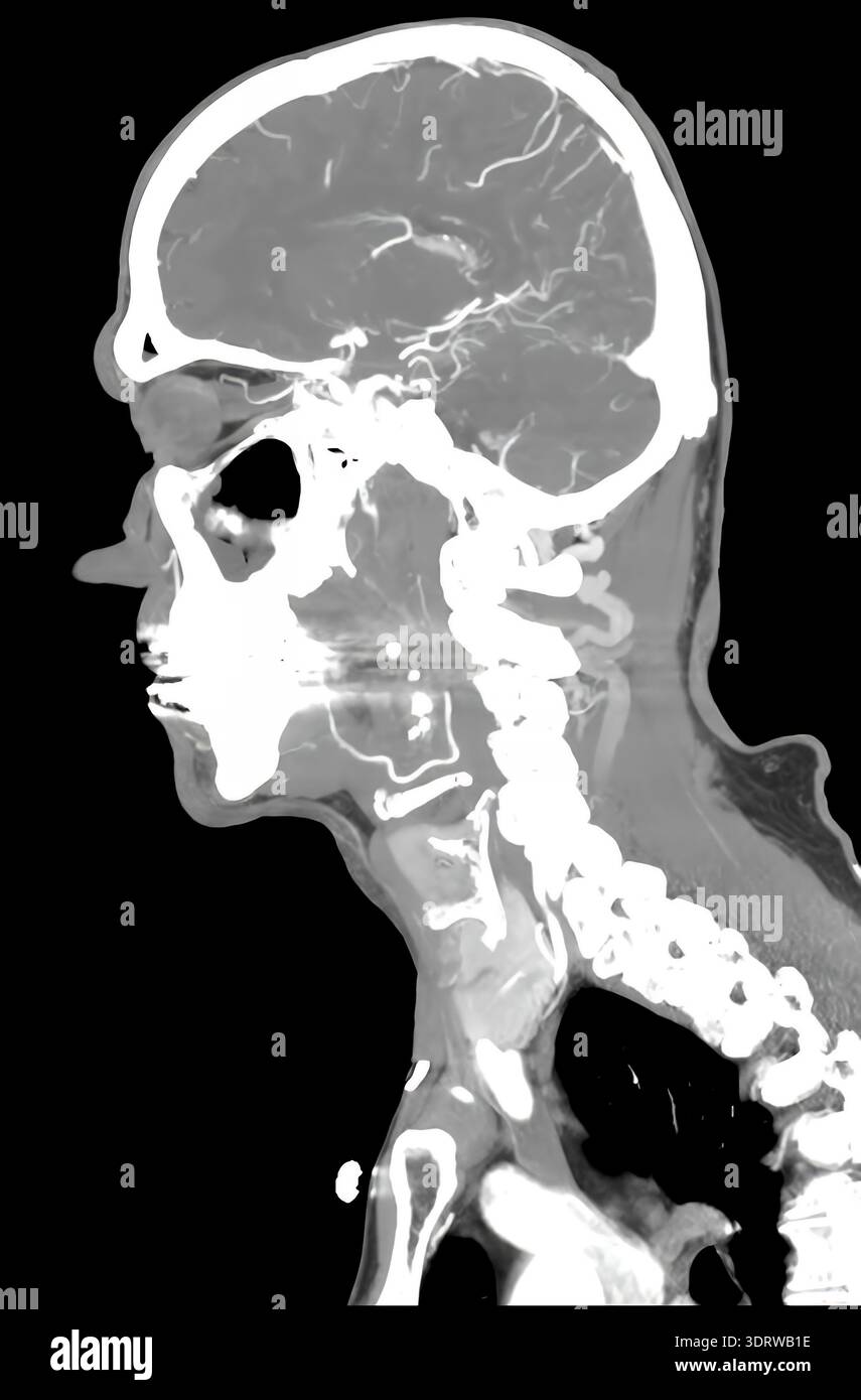 Scansione TC della testa umana che mostra il cervello e il sistema vascolare di un paziente maschio sano di 72 anni Foto Stock