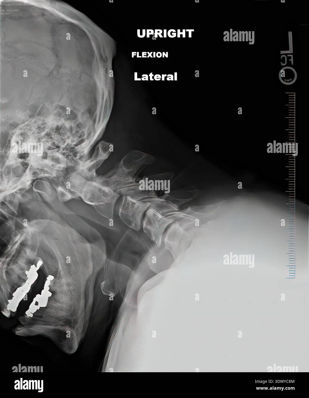 Radiografia del cranio umano e della colonna vertebrale che mostra la flessione della colonna cervicale, la struttura ossea e gli impianti dentali, visualizzando l'imaging diagnostico medico per un Foto Stock