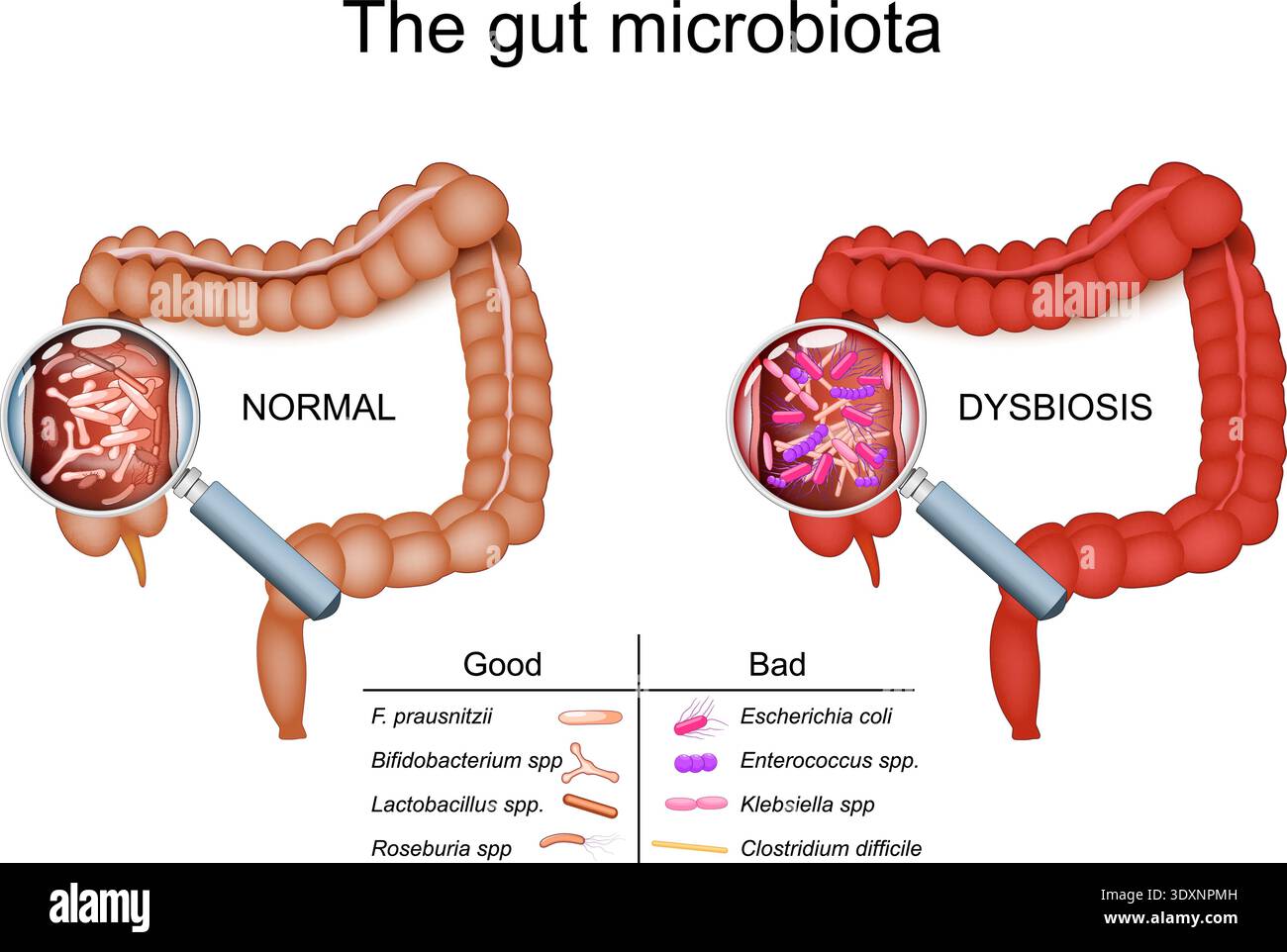 Il microbiota intestinale. Colon con buona bacntria e disbiosi dell'intestino crasso umano. flora intestinale. Illustrazione vettoriale. Diagramma medico. Illustrazione Vettoriale
