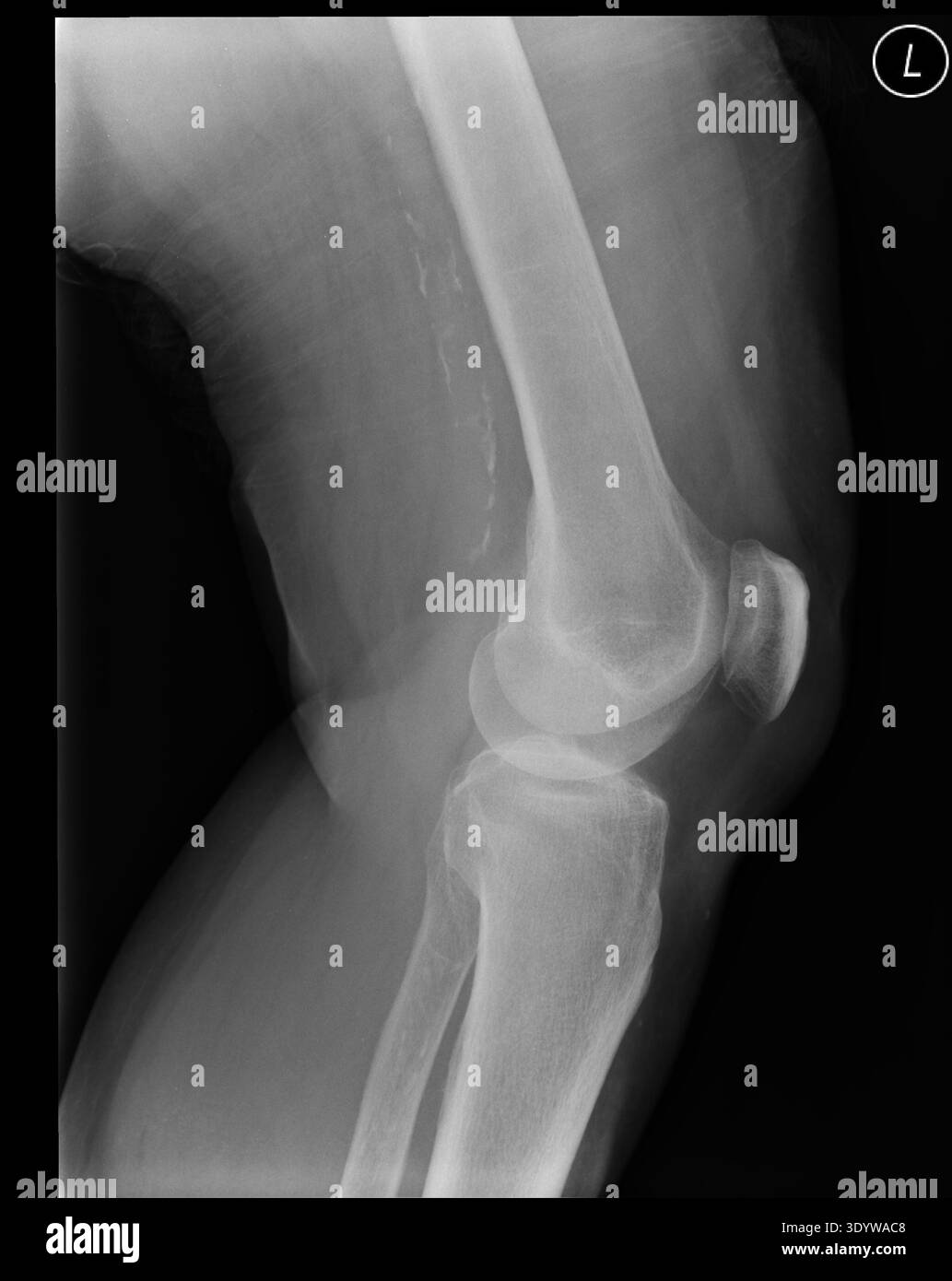 Una radiografia di un ginocchio umano (donna di settantatré anni), proiezione laterale Foto Stock