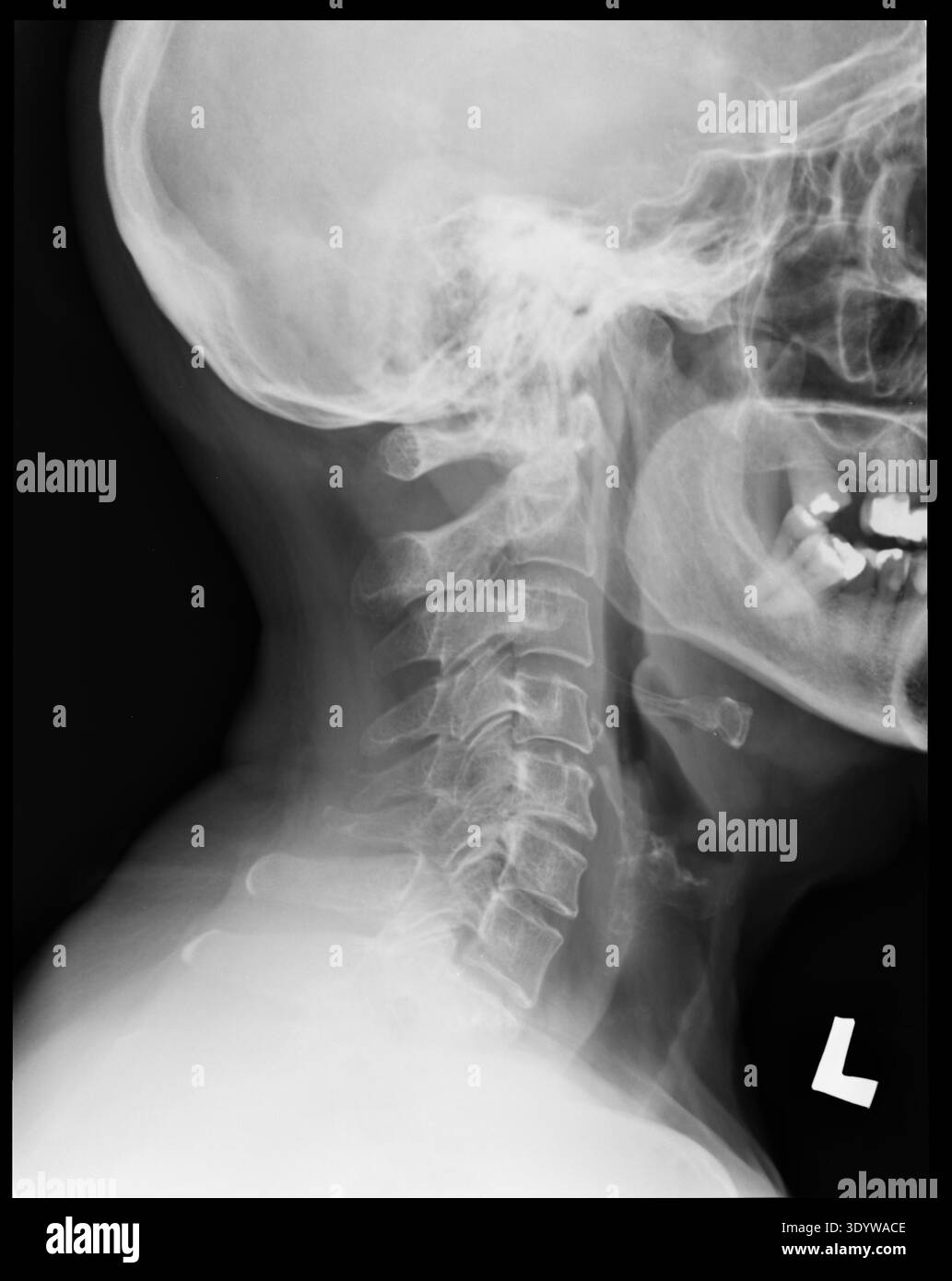 Sono visibili una radiografia della colonna cervicale laterale di una femmina di 67 anni, mandibola e denti Foto Stock